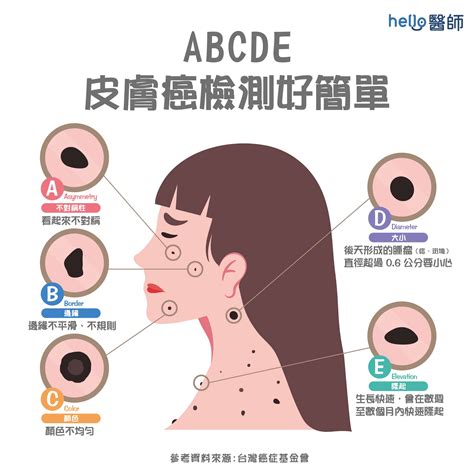 脖子長黑斑|皮膚長痣、長斑是皮膚癌前兆？皮膚癌初期4大症狀快。